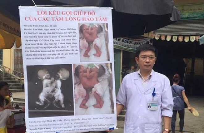 Bác sĩ ra chợ kêu gọi cứu hai bé dính liền: Những điều chưa biết