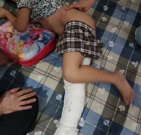 Học sinh lớp 2 gãy đôi xương đùi khi chơi trong sân trường: Phụ huynh đặt nghi vấn