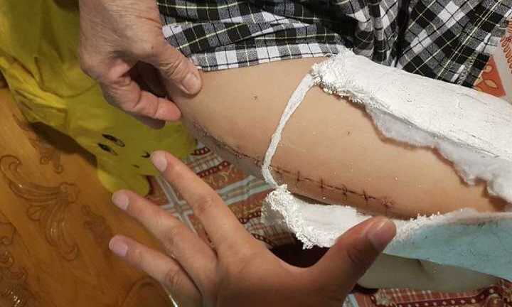 Học sinh lớp 2 gãy đôi xương đùi khi chơi trong sân trường: Tình tiết mới bất ngờ