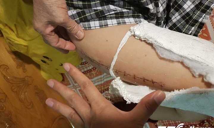 Học sinh gãy đôi xương đùi khi chơi trong sân trường: Thông tin mới nhất khiến phụ huynh bất ngờ