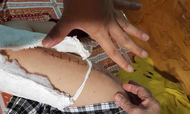 Học sinh lớp 2 bị gãy chân trong sân trường: Bộ trưởng GD-ĐT yêu cầu sớm kết luận