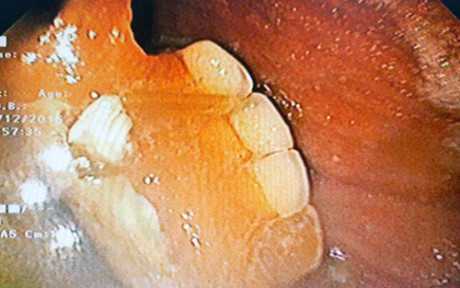 Bệnh nhân lỡ nuốt cả hàm răng giả, suýt đâm thủng dạ dày