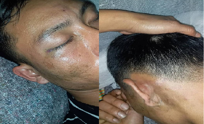 Nam thanh niên tố bị công an xã ở Hà Tĩnh tát đến thủng màng nhĩ