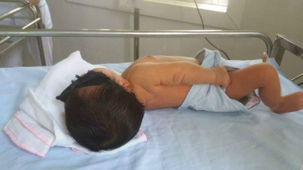 Em bé 8 ngày tuổi phải thay máu hoàn toàn do bị vàng da