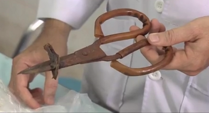 Cắt bỏ một phần xương sọ lấy cây kéo hoen rỉ khỏi đầu cháu bé ở Đồng Nai