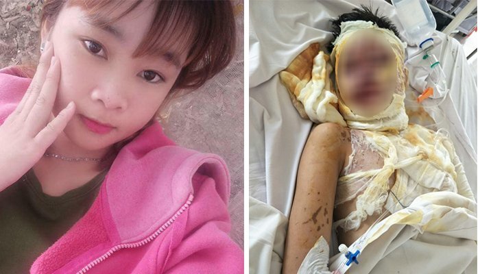 Xót thương thiếu nữ xinh đẹp bị tạt axit biến dạng gương mặt không có tiền chữa trị