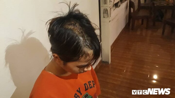 Bị nhóm thanh niên truy sát, bé gái 14 tuổi phải khâu gần 30 mũi