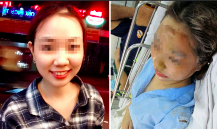 Đang đi đường, cô gái trẻ bị nam thanh niên tạt axit hỏng 2 mắt