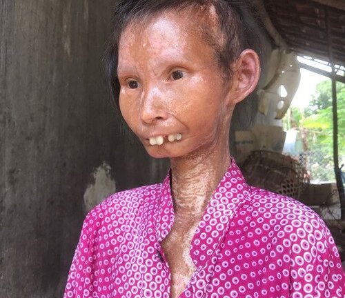 Người phụ nữ xinh đẹp mắc bệnh lạ 'hóa' bà lão nặng 24 kg