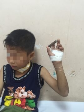 Thương tâm bé trai bị cành cây đâm xuyên qua cổ khi đang chơi đùa