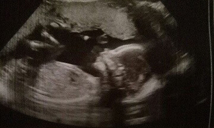 Chuyện lạ: Người phụ nữ có 2 âm đạo, 2 tử cung vẫn mang thai