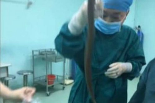 Luồn lươn sống vào cơ thể chữa táo bón, một bệnh nhân suýt chết