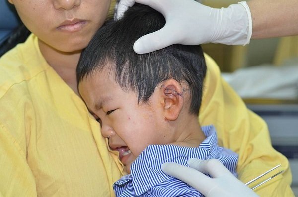 Thương tâm bé trai bị xe máy chở tôn cứa đứt ngang tai