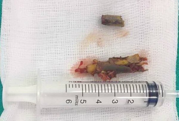 Kỳ tích: Phẫu thuật thành công cho bé trai bị cành cây đâm xuyên qua họng vào nền sọ