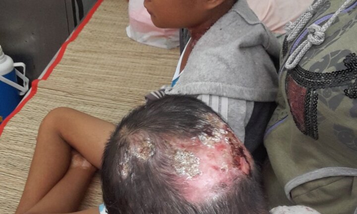 Hai anh em ruột quằn quại vì mắc bệnh da cánh bướm