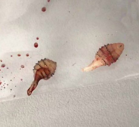 Phát hoảng khi thấy giòi chui ra từ chân sau chuyến du lịch