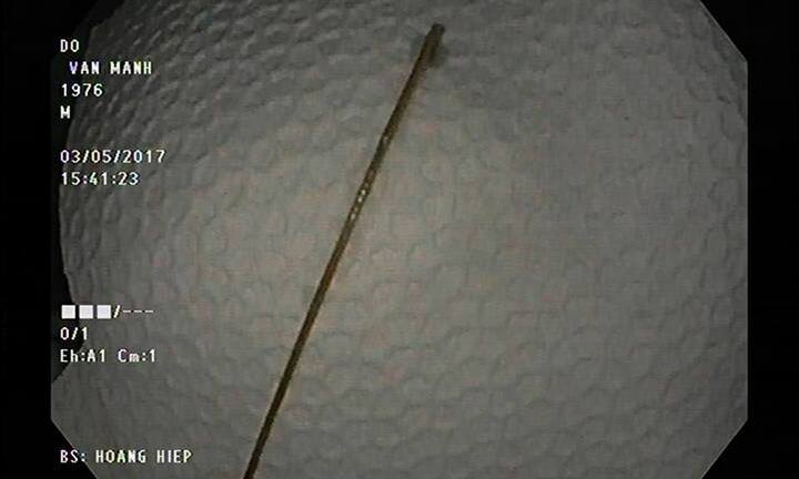 Suýt thủng dạ dày do... tăm lỡ rơi vào bụng