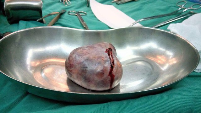 Nữ sinh 18 tuổi mắc bệnh viêm não hiếm gặp