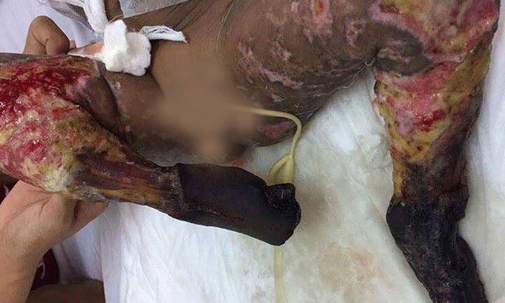 Quảng Nam: Tội nghiệp bé trai toàn thân tím đen, phải cắt bỏ hai chân