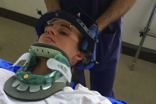 Cười và hắt hơi: Người phụ nữ bị trật đốt sống cổ