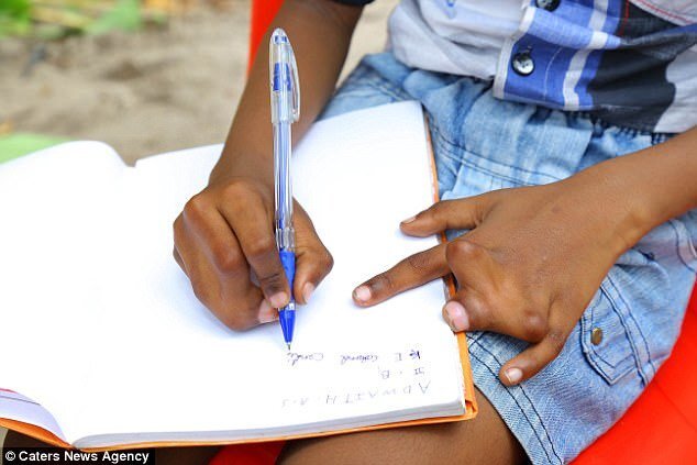 Sợ thần linh phạt, cả dòng họ bị dính liền ngón tay nhưng không dám phẫu thuật