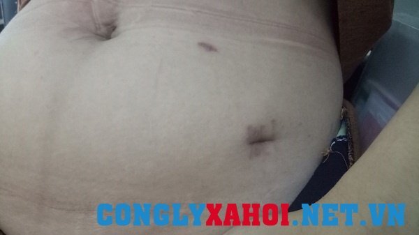 Hòa Bình: Bị u nang buồng trứng bên trái, bác sỹ mổ... bên phải