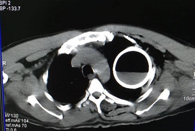 Hy hữu: Ngã cầu thang, bệnh nhân nuốt gọn chai thủy tinh