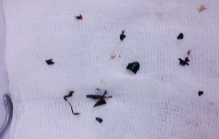 Há miệng đớp, bọ cánh cứng bay thẳng vào khí quản, bé 8 tháng suýt chết