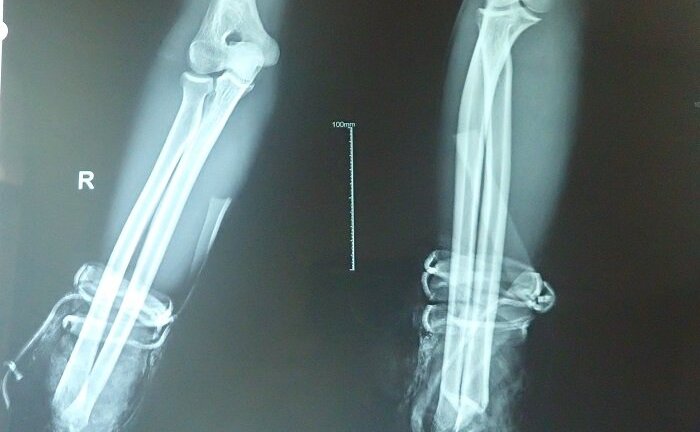 Nối thành công bàn tay bị đứt lìa do ẩu đả ở Khánh Hòa