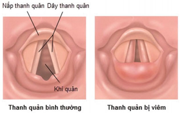 Suýt chết do ngạt thở vì hóc xương cá mà không đi khám