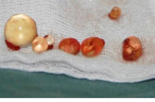 Hà Nội: Bác sỹ mổ lấy 7 khối u lổn nhổn do bệnh nhân bơm silicon vào 'của quý'