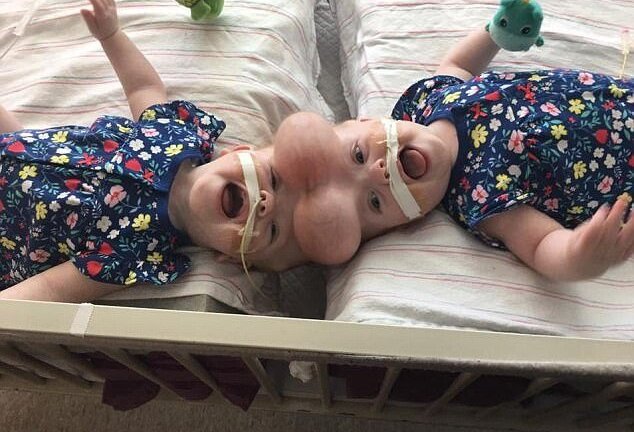 Phẫu thuật tách rời thành công cho cặp sinh đôi dính liền hiếm nhất thế giới