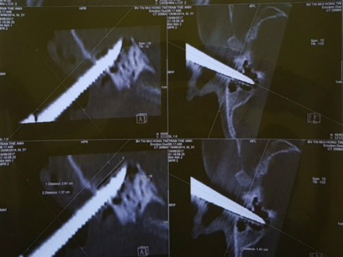 Nam Định: Cấp cứu cho bé trai bị mũi kéo cắm xuyên qua tai