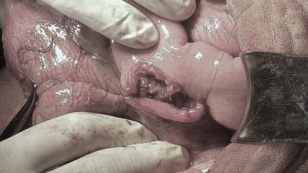 Vỡ tá tràng do bị cọc nhồi bê tông ép vào bụng