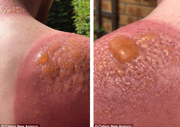 Hãi hùng với làn da phồng rộp, chảy mủ vì làm việc ngoài trời suốt 7 tiếng đồng hồ