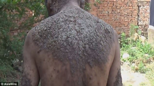 Gặp 'người cây' mắc bệnh lạ, toàn thân đóng vảy đáng sợ