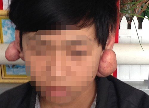 Kinh hoàng nổi u, phù tai sau khi bấm lỗ tai