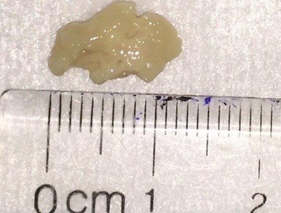 Hy hữu: Viêm phổi nặng do miếng thịt rơi vào khi sặc lẩu