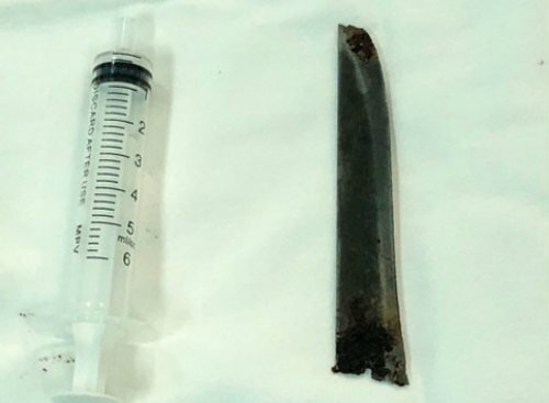 Choáng với lưỡi dao 12cm nằm trong lưng bệnh nhân nhiều năm nhưng không biết