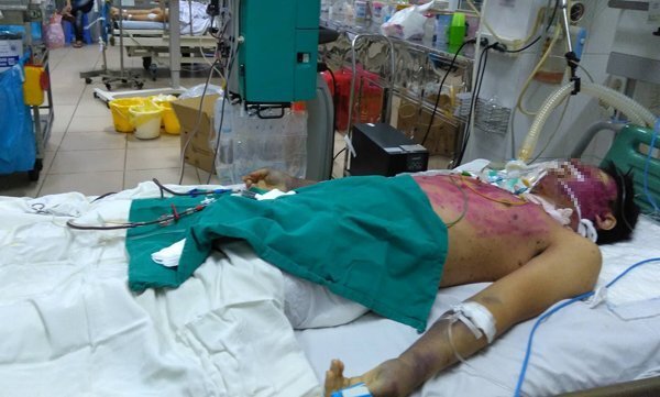 Biến chứng nặng do tự dùng thuốc chữa thủy đậu