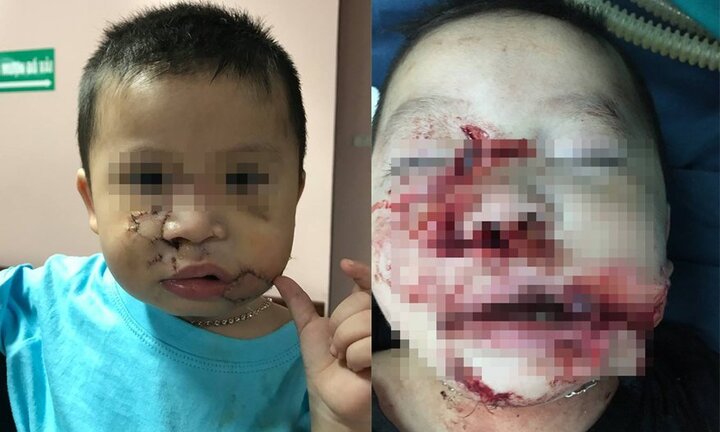 Phẫu thuật tạo hình thành công cho bé trai 21 tháng tuổi bị chó cắn nát mặt