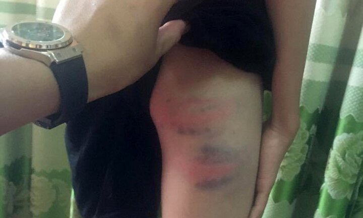 Nghi vấn cô giáo hành hạ con chồng dã man phải nhập viện