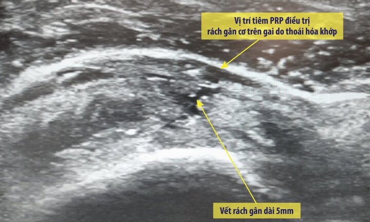 'Triệt' tận gốc viêm khớp vai bằng huyết tương giàu tiểu cầu