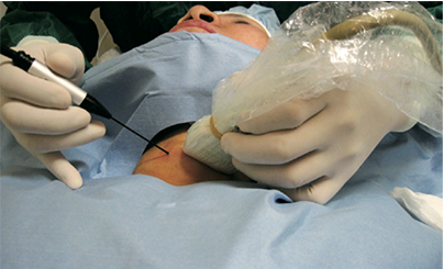 Điều trị bướu nhân tuyến giáp bằng sóng cao tần