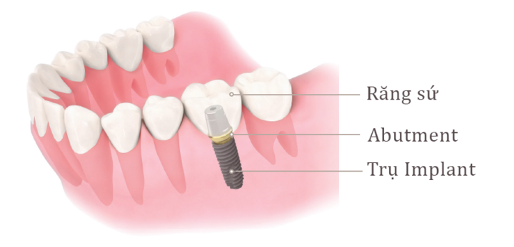 Mất răng hàm lâu năm có trồng lại được không?