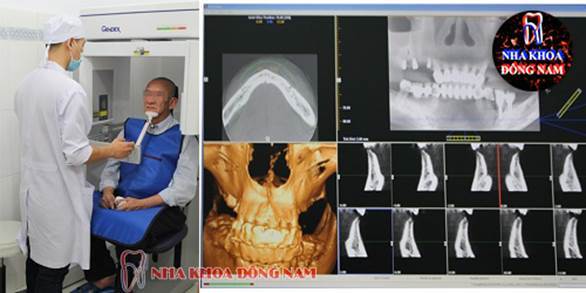 Cấy ghép răng Implant All-on-4 toàn hàm với chi phí tiết kiệm