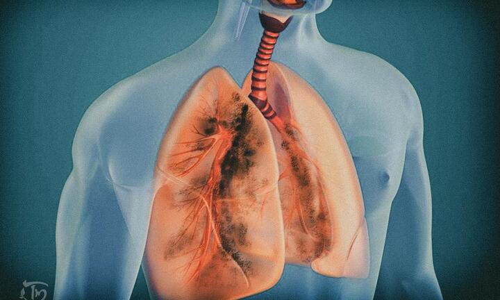 Viêm phế quản mãn tính khỏi triệt để nhờ Cao Bổ Phế Tâm Minh Đường