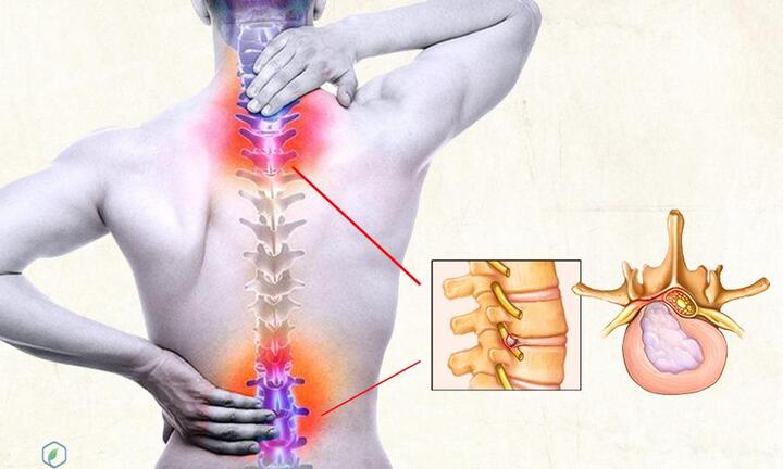 7 triệu chứng thoát vị đĩa đệm điển hình theo bác sĩ Nguyễn Bá Vưỡng