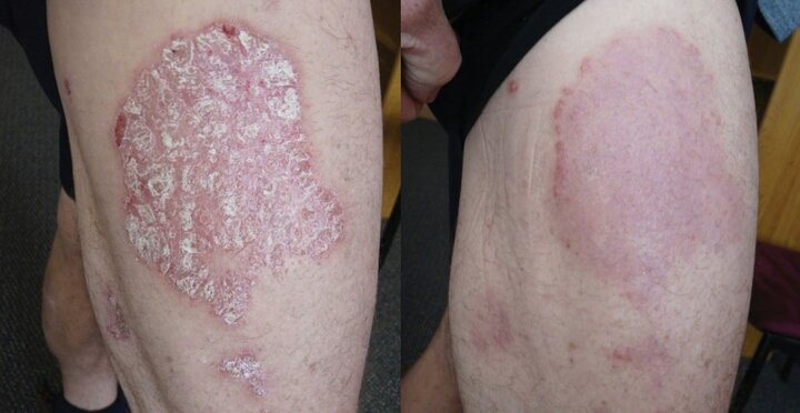 Giải pháp thảo dược hiệu quả cho bệnh vảy nến