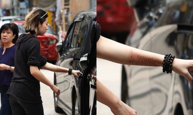 Con gái Thành Long lộ chi chít vết cứa trên tay sau khi xuất viện